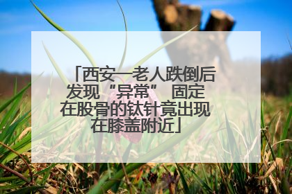 西安一老人跌倒后发现“异常” 固定在股骨的钛针竟出现在膝盖附近